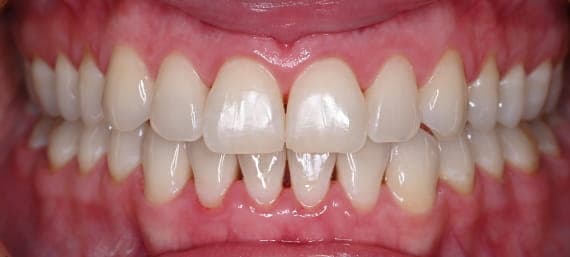 Case 1 after