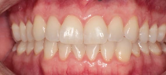 Case 1 before