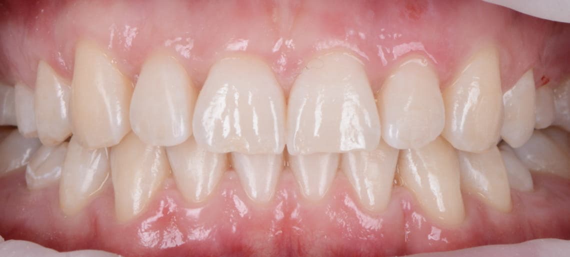 Case 4 after