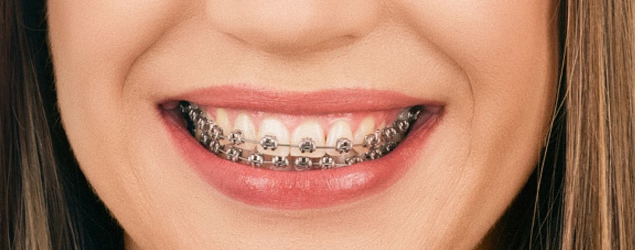 Braces patient
